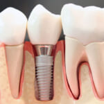 インプラント治療