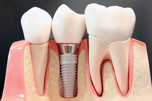 インプラント治療