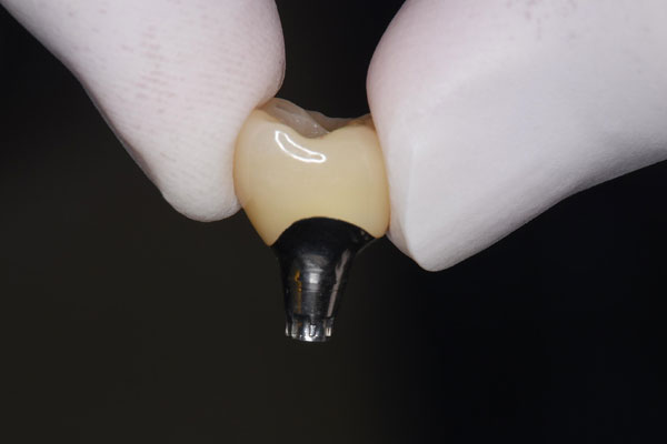 上部構造(人工歯)の装着