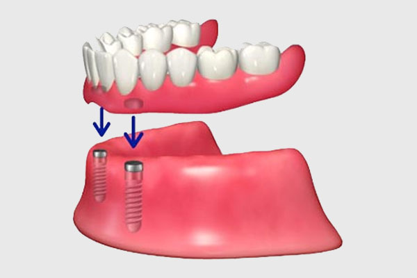 インプラントオーバーデンチャー