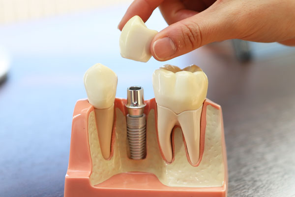 インプラント治療