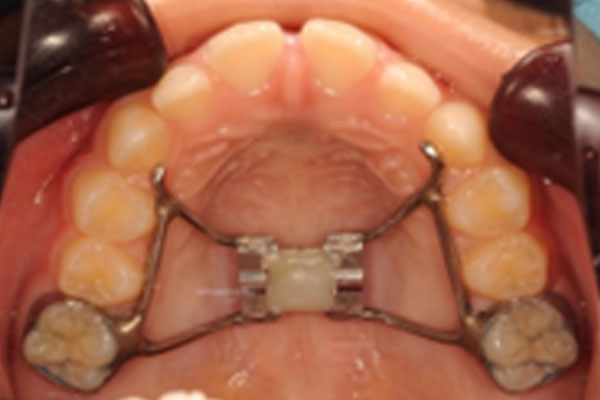 固定装置(床矯正)
