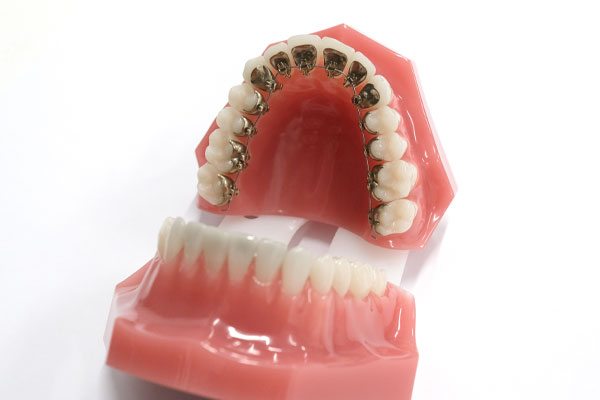 ワイヤー矯正(裏側)