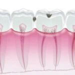 C1:エナメル質までの浅い虫歯