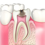 C3:神経まで到達した虫歯1