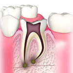 C3:神経まで到達した虫歯2