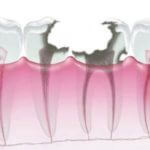 C4:ほとんど歯がない虫歯