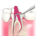 C3:神経まで到達した虫歯2