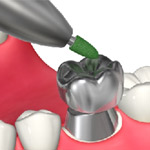 C3:神経まで到達した虫歯3