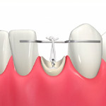 ほとんど歯がない虫歯の治療2