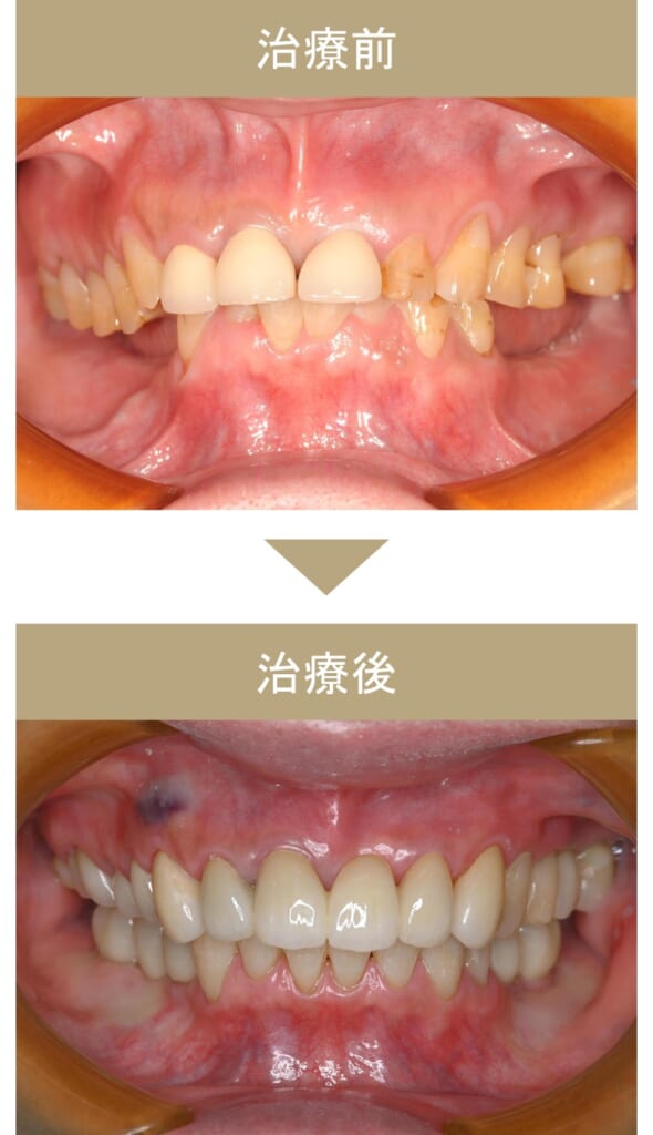 フルマウス治療の症例その1-1
