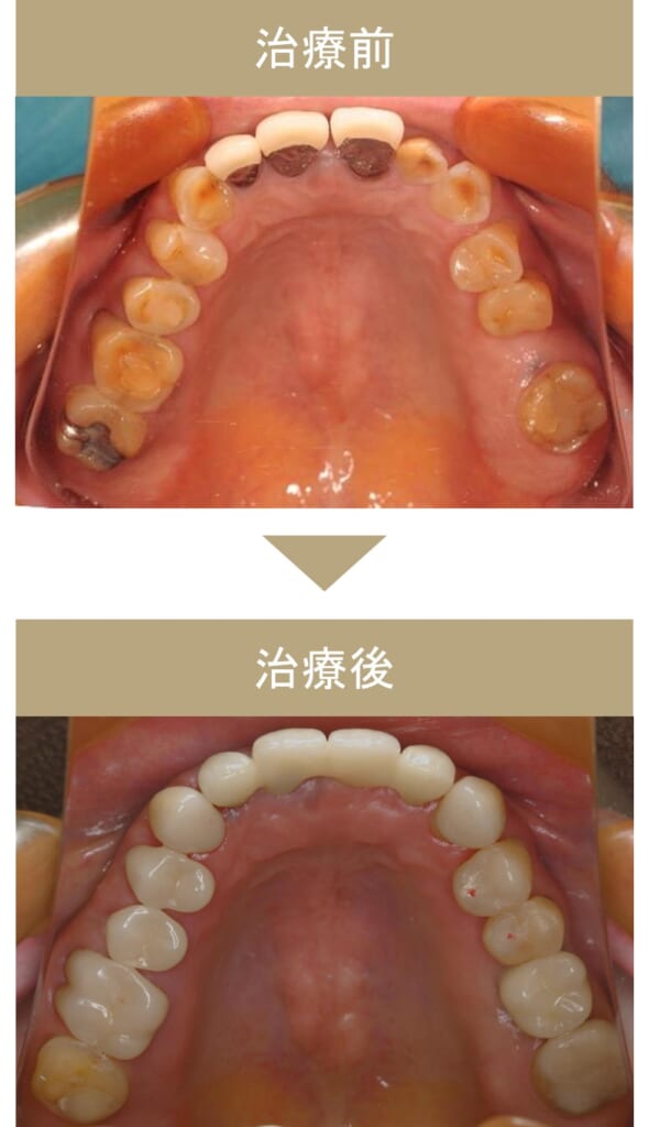 フルマウス治療の症例その1-2
