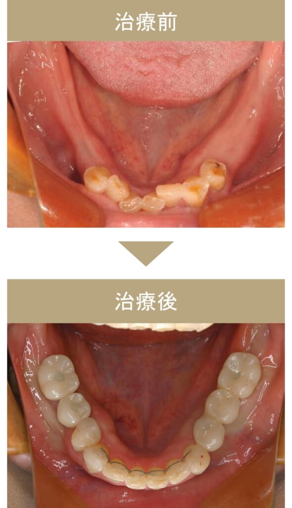 フルマウス治療の症例その1-3