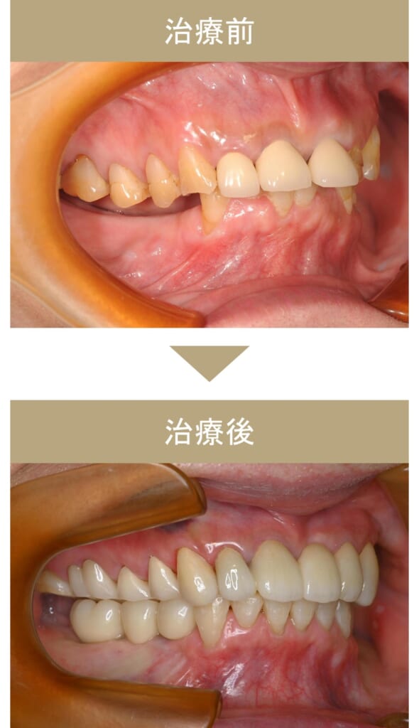 フルマウス治療の症例その1-4