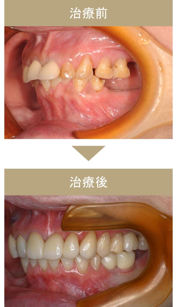 フルマウス治療の症例その1-5