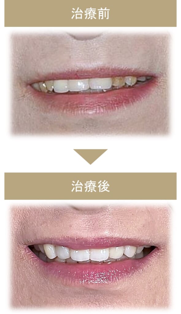 フルマウス治療の症例その1-6