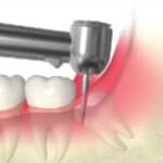 分割・歯冠部の除去