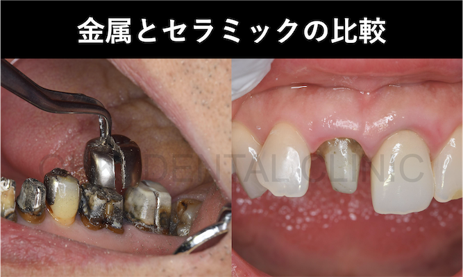 銀歯とセラミック