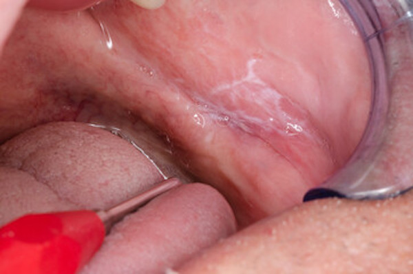 金属アレルギー