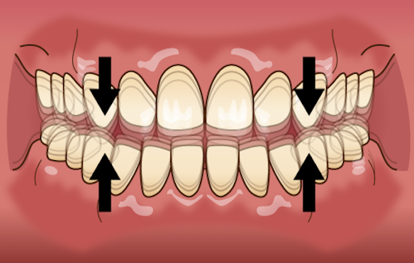 歯ぎしり-タッピング