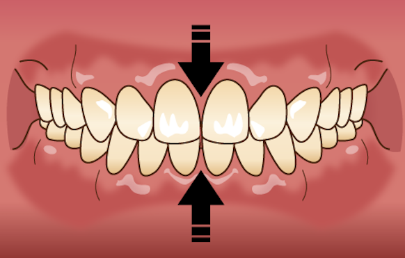 歯ぎしり-クレンチング
