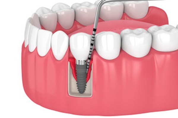 インプラント周囲炎